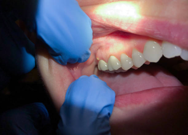 Best Emergency Tooth Extraction in Westland, MI