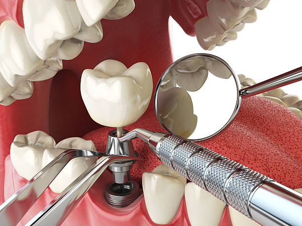 Best Emergency Root Canal Treatment in Westland, MI